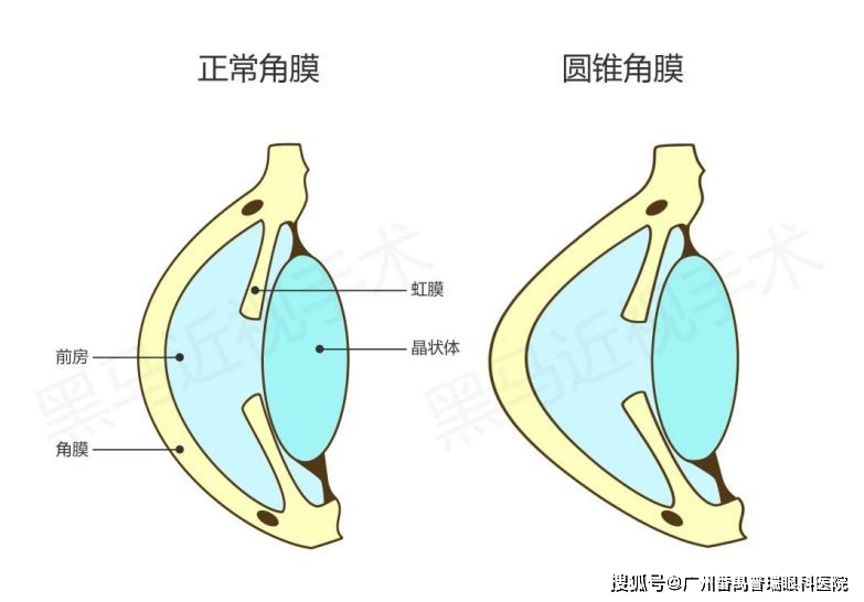 人工智能+医疗 刘泉教授：或辅助分析，初判能否近视手术